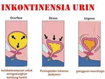 inkontinensia urine